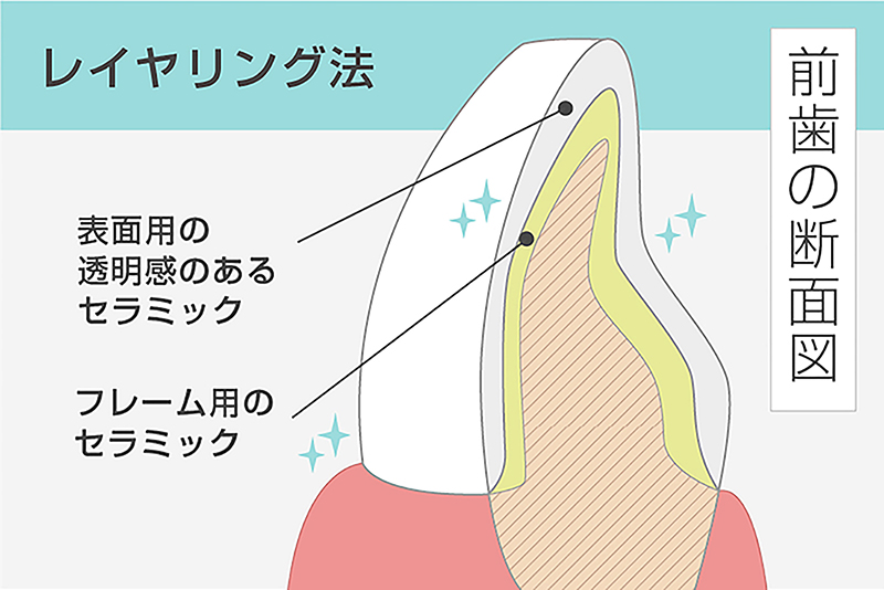 プレミアムセラミッククラウン