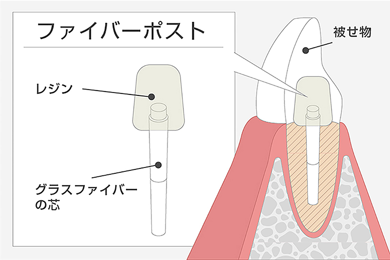 ファイバーポスト