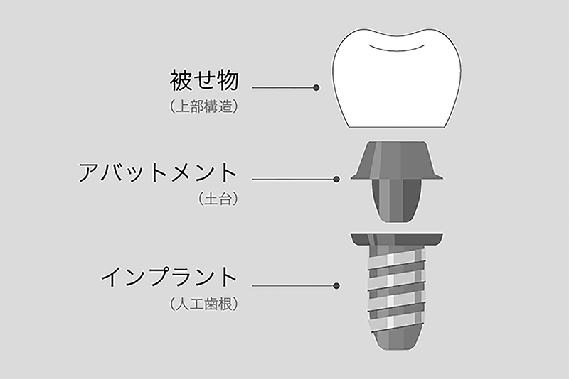 インプラントの構造