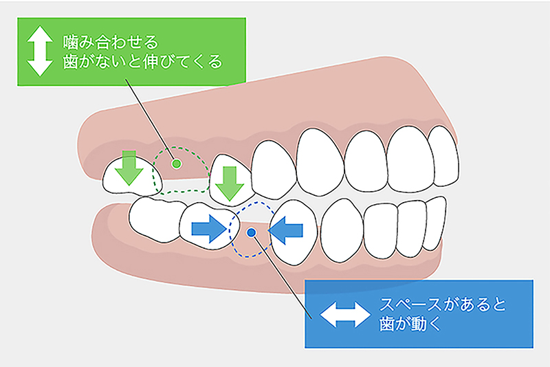 歯を失った後の治療の選択肢