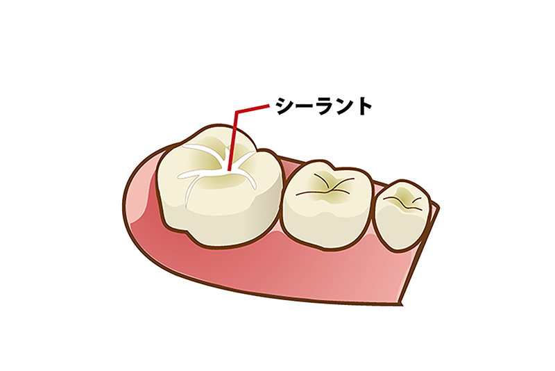 シーラント