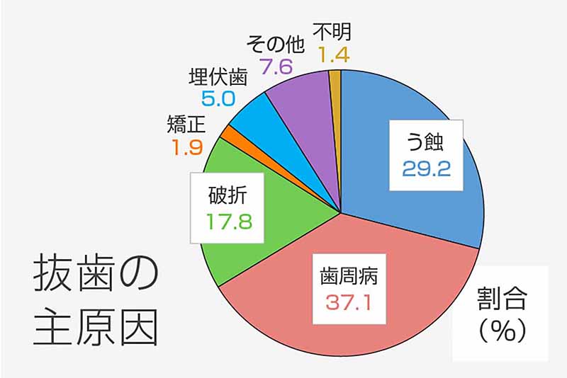 ー公益社団法人8020推進財団(2018) 第2回永久歯の抜歯原因調査