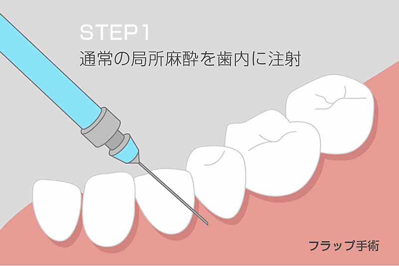 通常の局所麻酔を歯内に注射