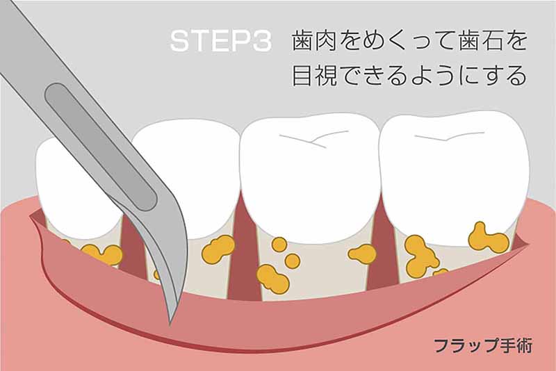 歯肉をめくって歯石を目視できるようにする