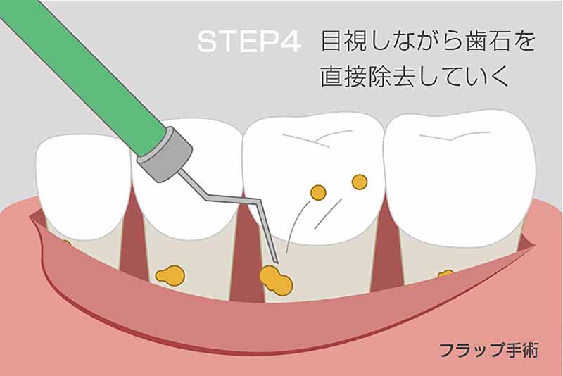 目視しながら歯石を直接除去していく
