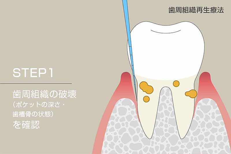 歯周組織の破壊(ポケットの深さ・歯槽骨の状態)を確認