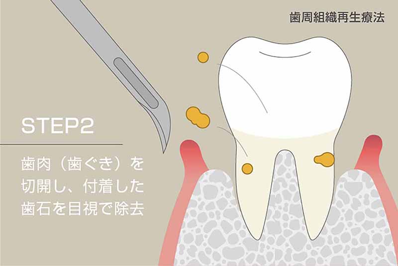 歯肉(歯ぐき)を切開し、付着した歯石を目視で除去