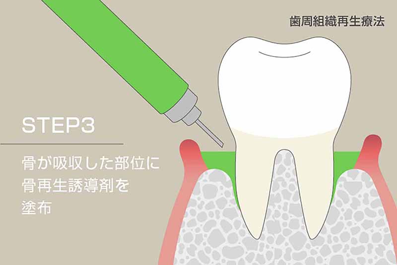 骨が吸収した部位に骨再生誘導薬剤を塗布
