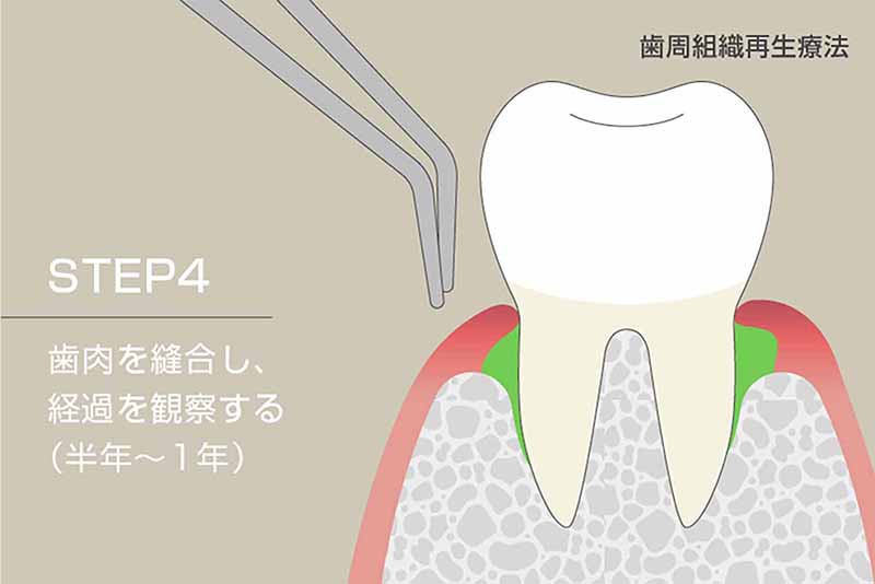 歯肉を縫合し、経過を観察(半年〜1年)